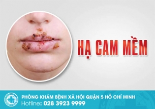 Bệnh hạ cam là gì? Nguyên nhân, triệu chứng và cách điều trị hiệu quả