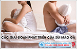 Các giai đoạn phát triển của bệnh sùi mào gà