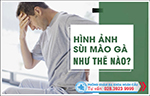 Hình ảnh về bệnh sùi mào gà và những mô tả chi tiết về bệnh