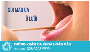 Bất ngờ trước việc mọc sùi mào gà ở lưỡi