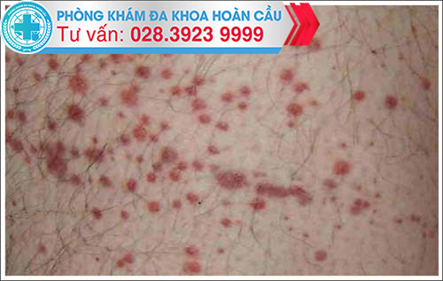 nổi mụn do bệnh giang mai