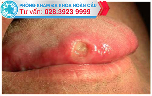 Mụn rộp sinh dục ở miệng - do Oral sex