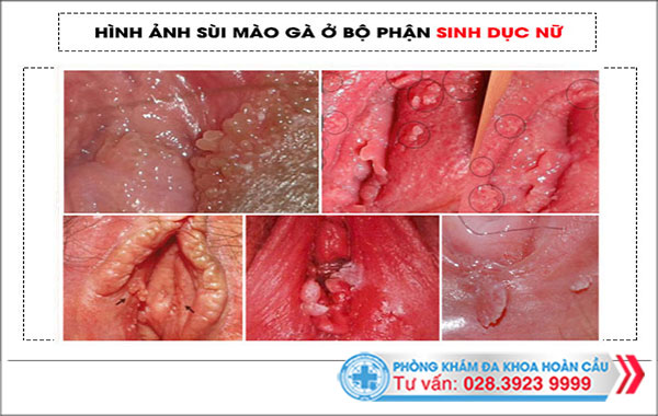 giai đoạn phát triển của sùi mào gà