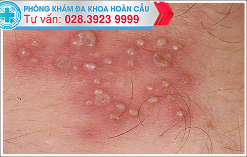 nốt mụn do bệnh mụn rộp sinh dục