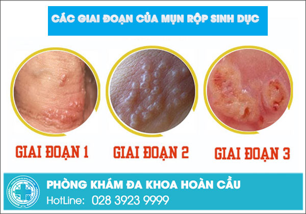 Những triệu chứng mụn rộp sinh dục qua từng giai đoạn 