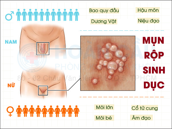 Mụn rộp sinh dục