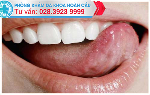 tìm chuyên gia ngay khi có dấu hiệu sùi mào gà