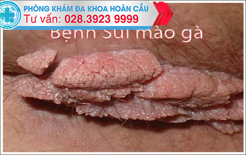sùi mào gà tại cơ quan sinh dục nữ