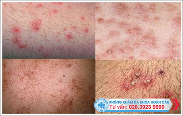 Mụn vùng kín do viêm nang lông